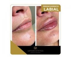 Preenchimento Labial em Guarulhos