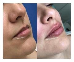 Preenchimento Labial em Guarulhos