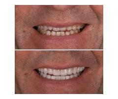 Implante dentário em São Paulo: Conheça a melhor clínica de Moema para um sorriso perfeito