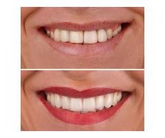 Implante dentário em São Paulo: Conheça a melhor clínica de Moema para um sorriso perfeito